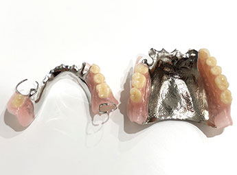 金属床入れ歯の画像