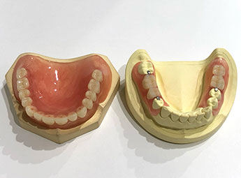 ノンクラスプ入れ歯の画像